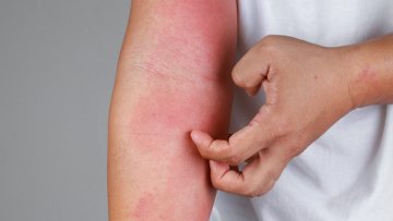 Atelier découverte - L'origine des maladies de peau selon l'Ayurveda